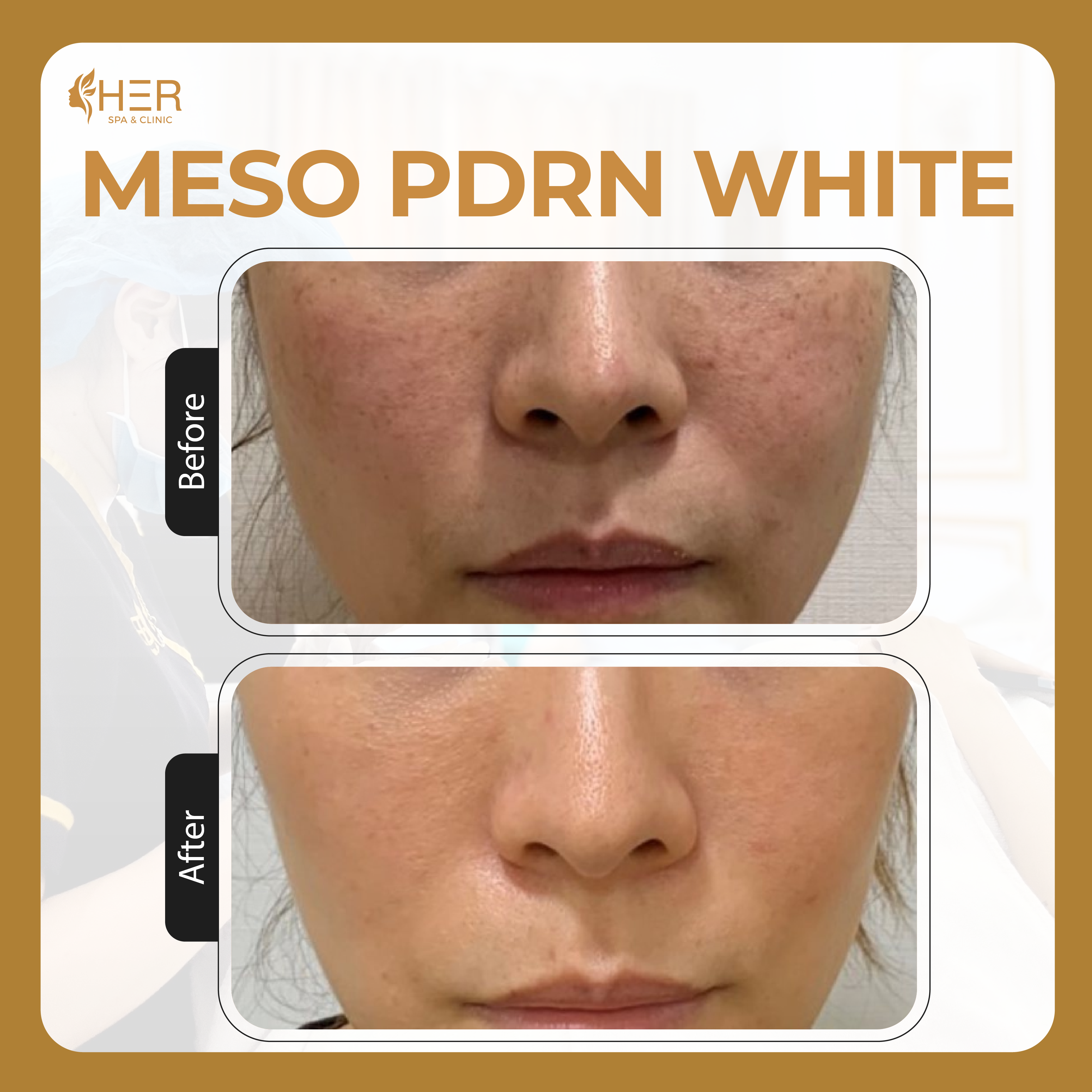 Meso PDRN White - Mesotherapy phục hồi cấu trúc & làm sáng